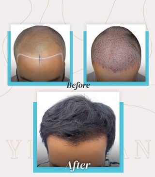 Slider image (4) United Hair Clinic